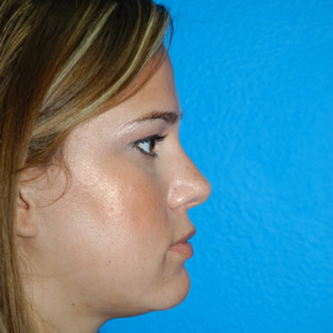 Rhinoplasty