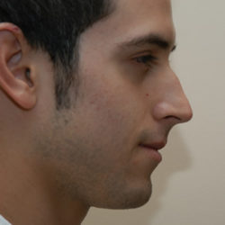 Rhinoplasty