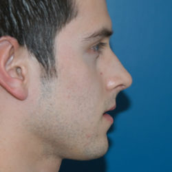 Rhinoplasty