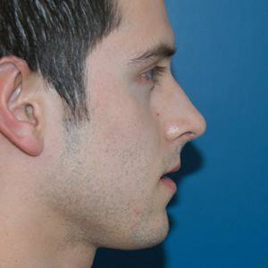 Rhinoplasty