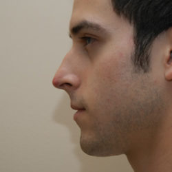 Rhinoplasty