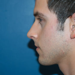 Rhinoplasty