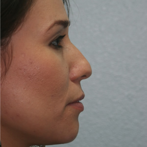 Rhinoplasty