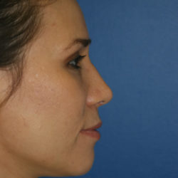 Rhinoplasty