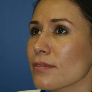 Rhinoplasty