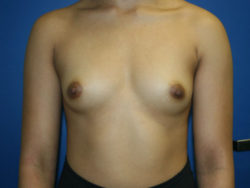 Breast Augmentation