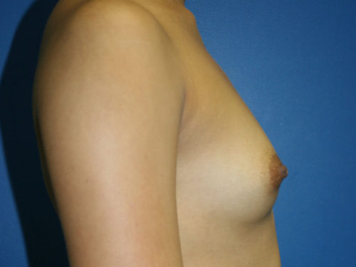 Breast Augmentation