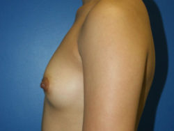 Breast Augmentation