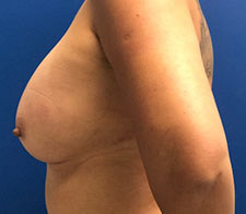 Breast Augmentation