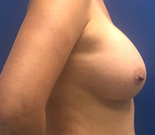 Breast Augmentation