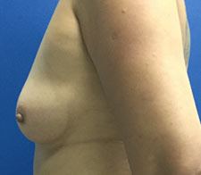 Breast Augmentation