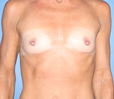 Breast Augmentation