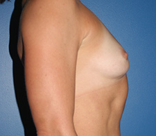 Breast Augmentation