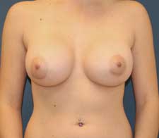 Breast Augmentation Case 575 After Photo Breast Augmentation