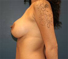 Breast Augmentation