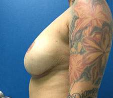 Breast Implant Removal (Explant)