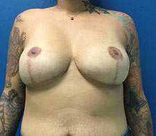 Breast Implant Removal (Explant)