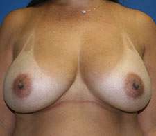 Breast Implant Removal (Explant)