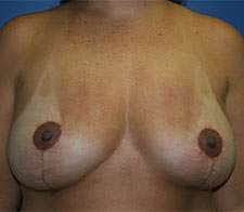 Breast Implant Removal (Explant)