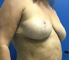 Breast Implant Removal