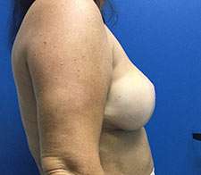 Breast Implant Removal (Explant)