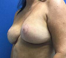 Breast Implant Removal (Explant)