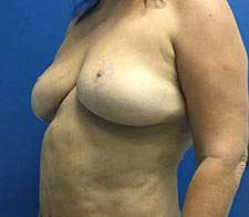 Breast Implant Removal (Explant)