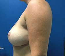 Breast Implant Removal (Explant)