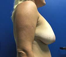 Breast Implant Removal (Explant)