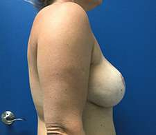 Breast Implant Removal (Explant)