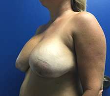 Breast Implant Removal (Explant)