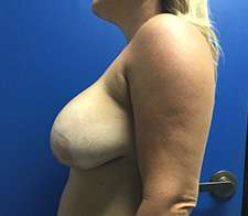 Breast Implant Removal (Explant)