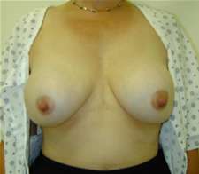 Breast Implant Removal (Explant)