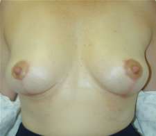 Breast Implant Removal (Explant)