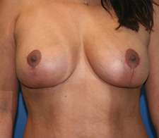 Breast Lift Case 725 After Photo Breast Lift