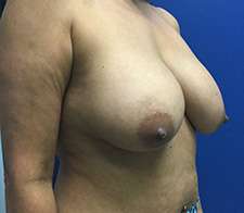 Breast Lift