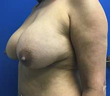 Breast Lift