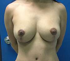 Breast Lift with Augmentation