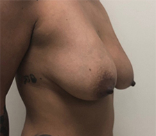 Breast Lift with Augmentation