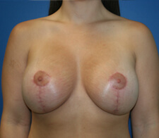 Breast Lift with Augmentation Case 787 After Photo Breast Lift with Augmentation