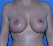 Breast Lift with Augmentation