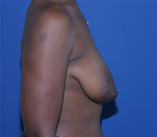 Breast Lift with Augmentation