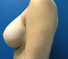 Breast Revision