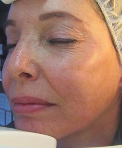 Laser Resurfacing