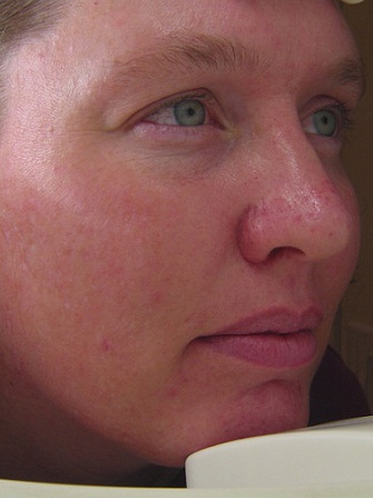 Photofacial – IPL