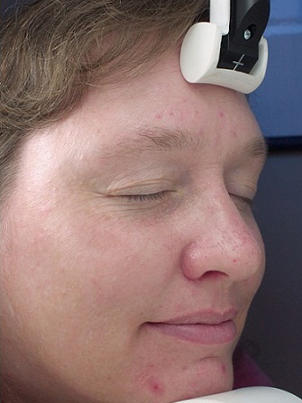 Photofacial – IPL