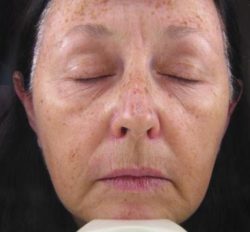 Photofacial – IPL