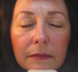 Photofacial – IPL