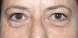 Eyelid Surgery