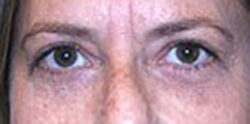 Eyelid Surgery